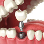 Closeup of a dental implant, abutment, and dental crown to replace a missing tooth with a tooth replacement in Cedar Park