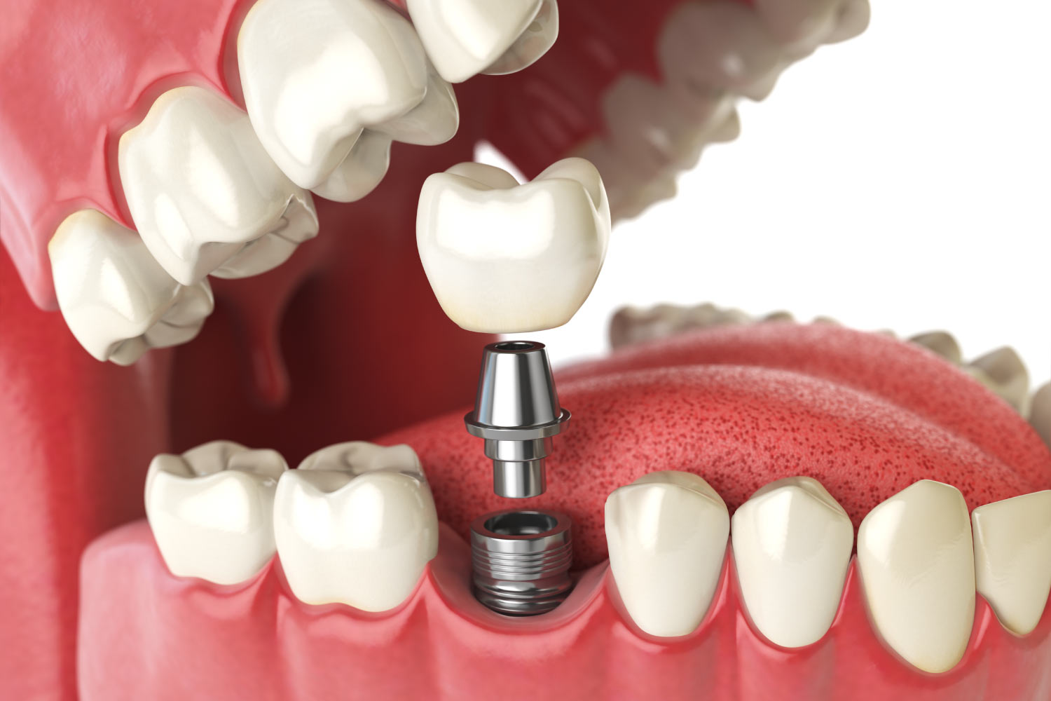 Closeup of a dental implant, abutment, and dental crown to replace a missing tooth with a tooth replacement in Cedar Park