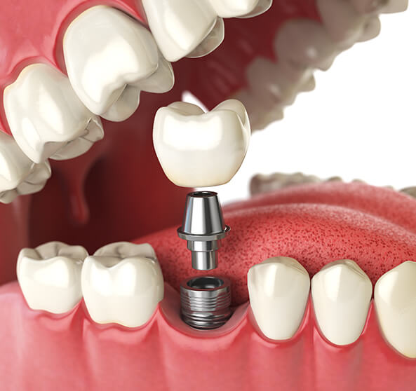 illustration of a dental implant