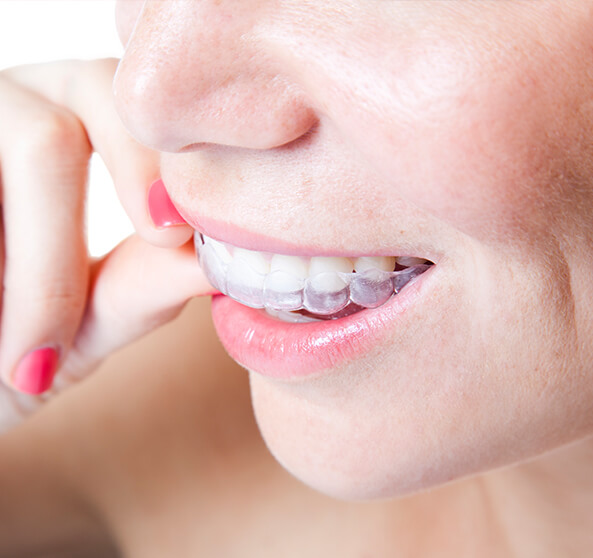 woman putting in clear aligners
