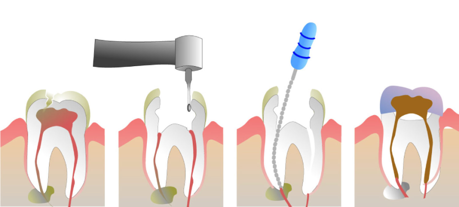 Graphic showing the four parts of root canal therapy.