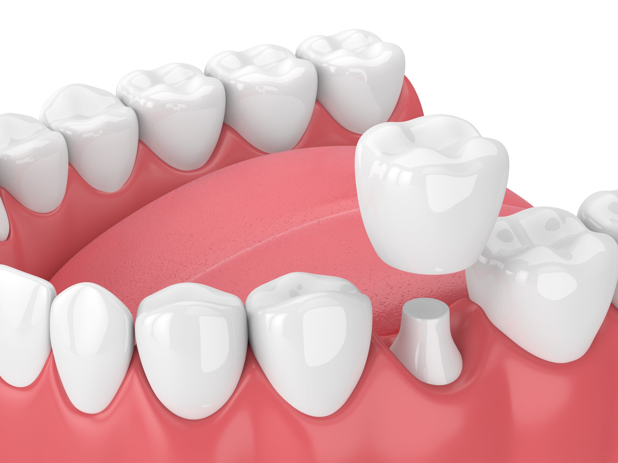 dental crown rendering