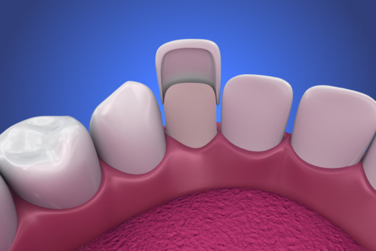 Model showing a veneer being placed on a tooth.