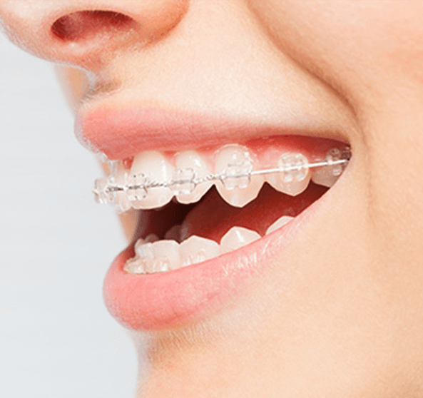 woman with ceramic braces