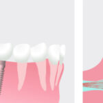 Graphic showing a dental implant topped with a crown.