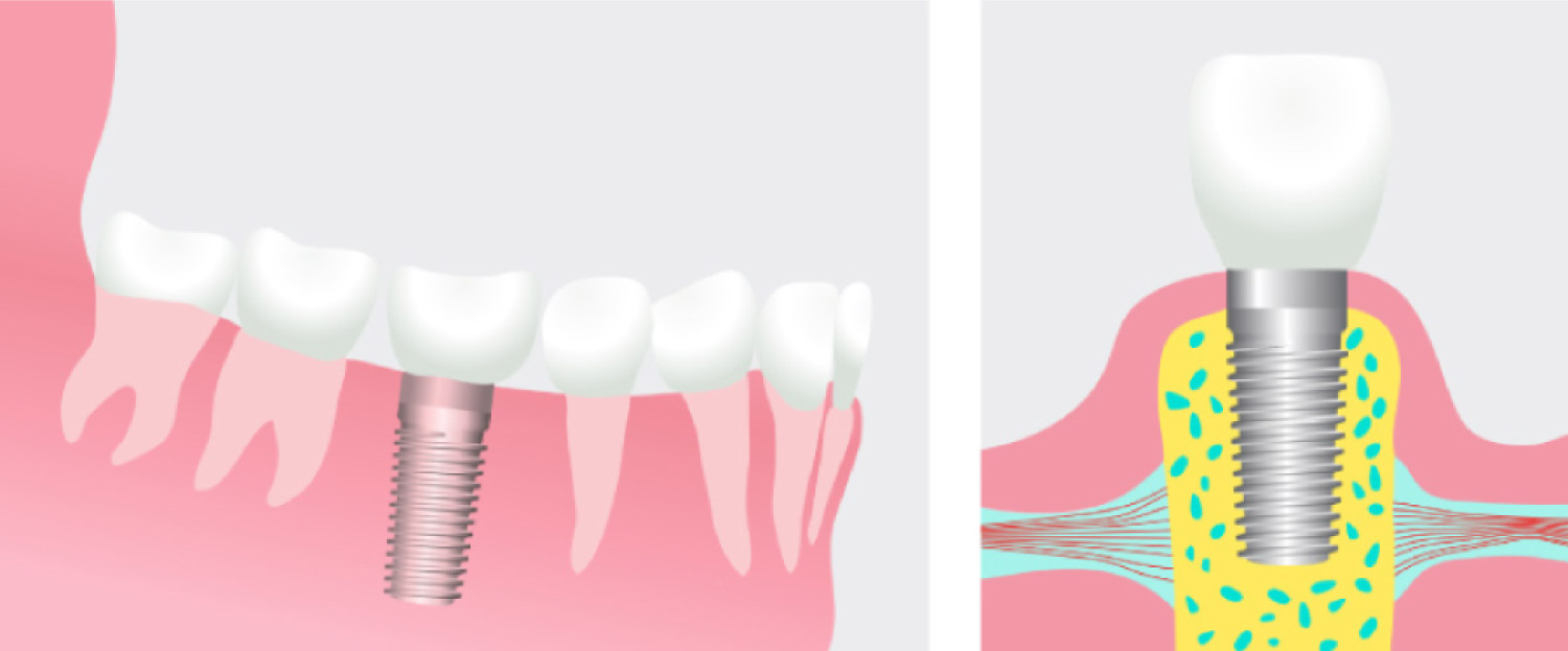 Graphic showing a dental implant topped with a crown.