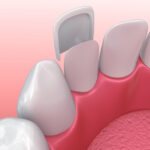 Technical image of dental veneers.