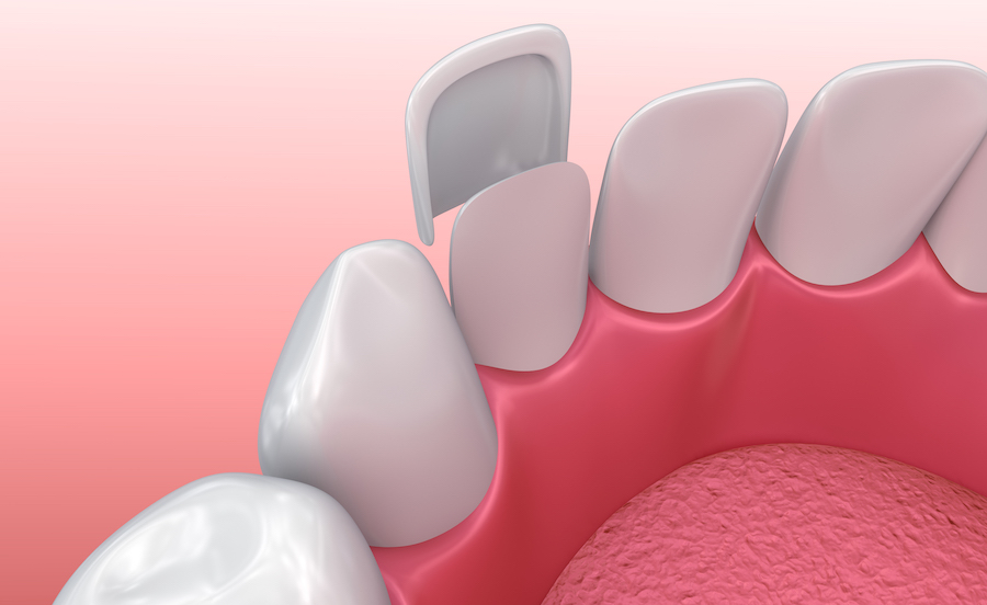 Technical image of dental veneers.