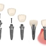 graphic illustration of dental implant parts, including abutment, implant post, implant crown, Cedar Park TX, dental implants, abutment placement