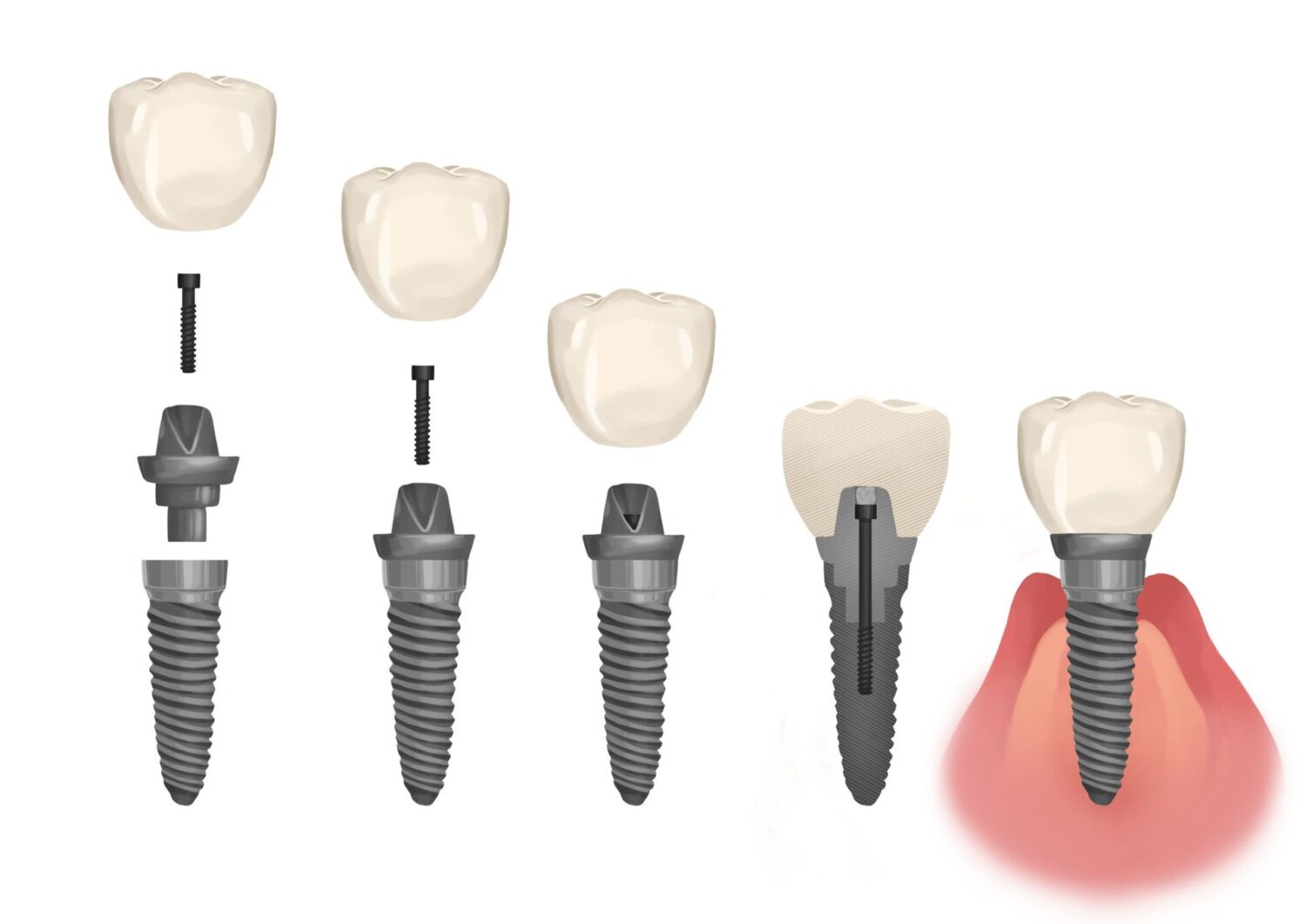 graphic illustration of dental implant parts, including abutment, implant post, implant crown, Cedar Park TX, dental implants, abutment placement