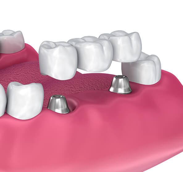 illustration of a dental bridge