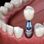 dental implants